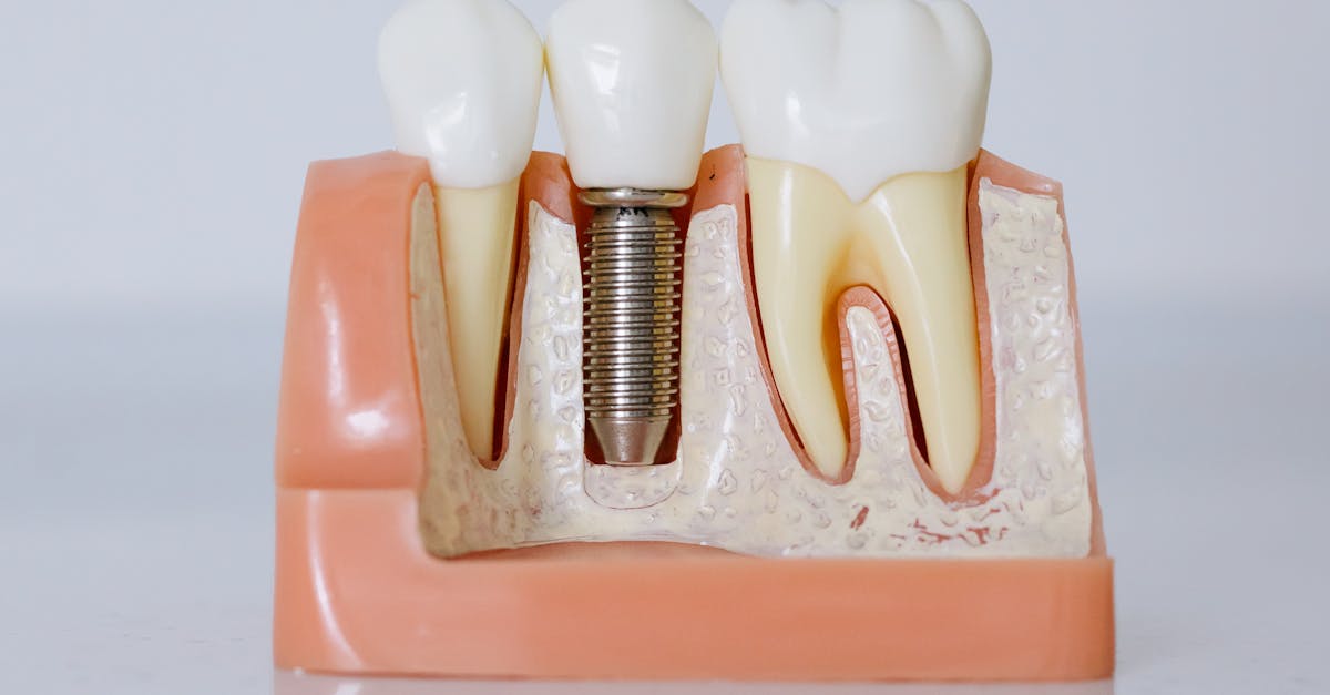 Anesthesia Options for Single Tooth Implants  