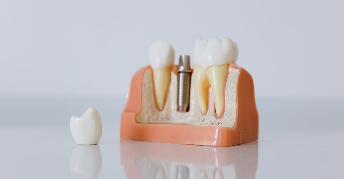 Common Complications of Single Tooth Implants  