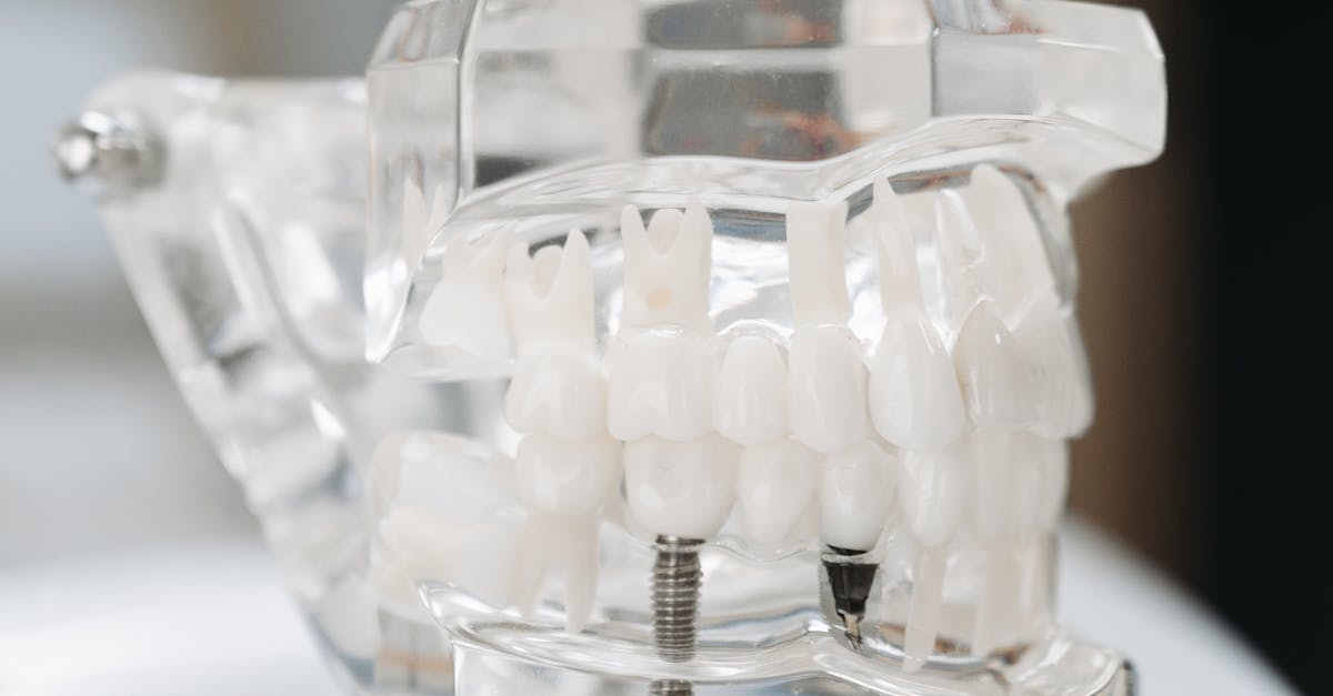 Factors Affecting the Success of Single Tooth Implants  