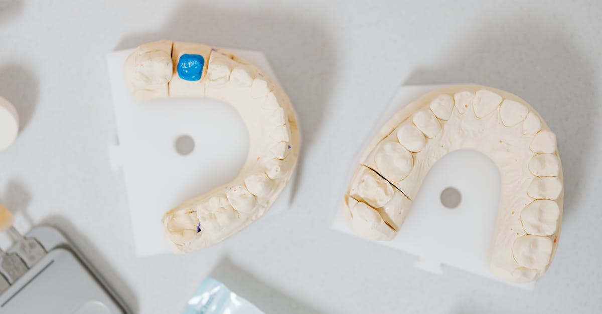 How Long Does a Single Tooth Implant Last?  